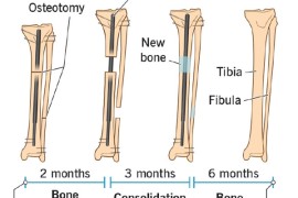 增高10厘米不满足：男子为长到1米93二次砸断腿骨手术增高 花57万