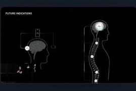 马斯克：首例人类脑机芯片植入，患者恢复良好