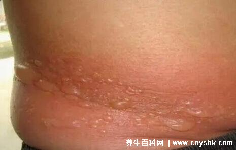 艾滋病一开始的皮肤图，不瘙痒红色斑疹1-3周消退(伴发热/乏力)-图8