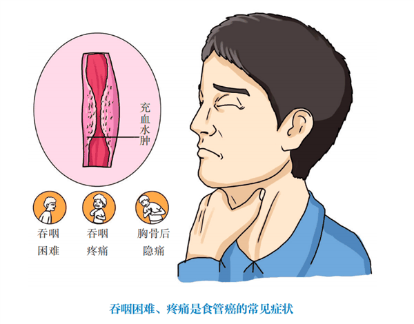 “吃出来”的癌症！喉咙出现这4种症状 就要小心了-图4
